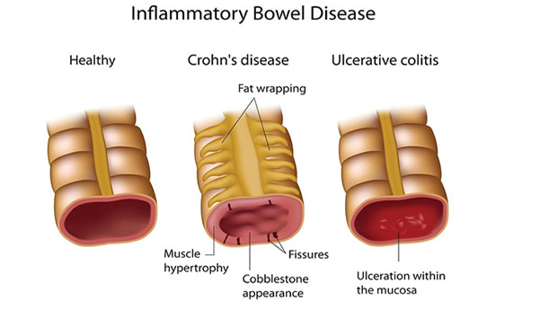 Inflammatory Bowel Disease - Asheville Functional Medicine