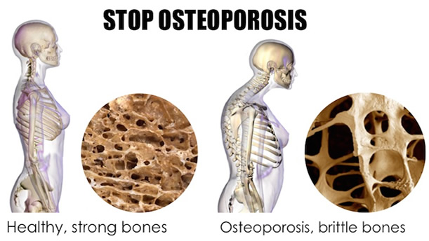 Osteoporosis - Asheville Functional Medicine