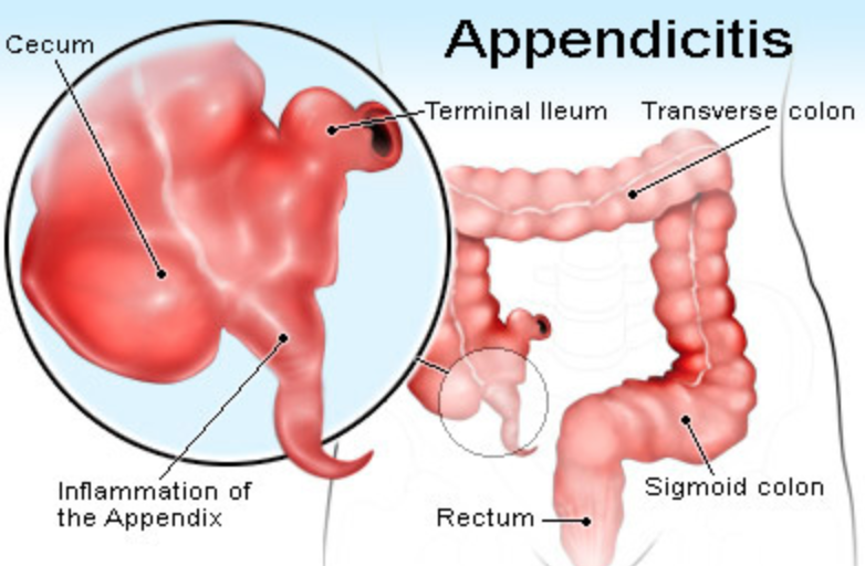 Case Study - Appendicitis - True Health - Functional Medicine