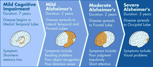 alzheimer's stages